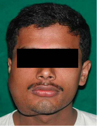 Gambar 2. Ameloblastoma mandibula (Sumber: https://atlasgeneticsoncology.org/solid-tumor/5945/head-and-neck-odontogenic-tumor-ameloblastoma) 